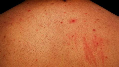 How To Get Rid Of Back Acne Bacne And Chest Acne Howcast