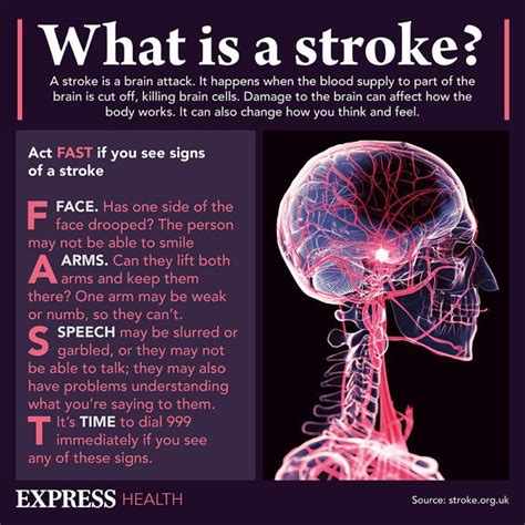 Stroke Symptoms Eight Subtle Signs Of A Brain Attack Call 999 Now Uk