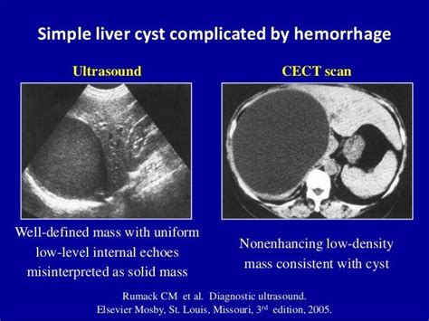 Cystic Liver Lesions An Ultrasound Perspective
