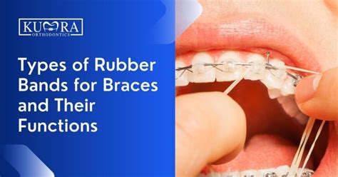 Types Of Rubber Brands For Braces And Their Functions Kumra Orthodontics