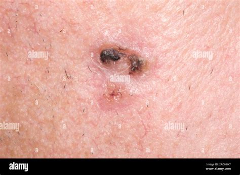 Basal Cell Carcinoma Bcc Or Rodent Ulcer On A 73 Year Old Mans