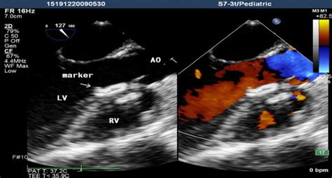 Minimally Invasive Perventricular Device Closure Of Perimembranous