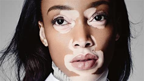 Model Chantelle Winnie Has A Skin Condition Vitiligo — And A Top Career