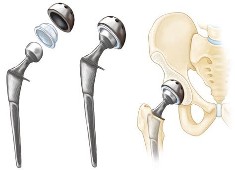Total Hip Replacement Orthoinfo Aaos
