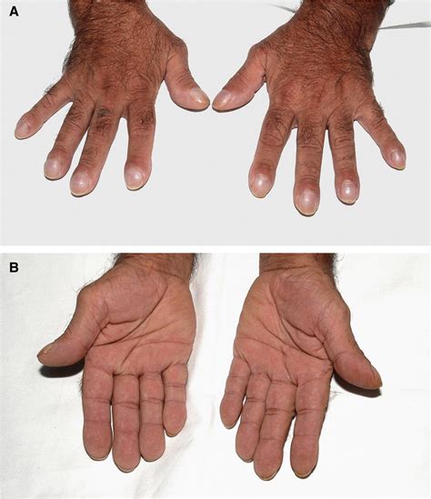 Treatment Of Painful Hypertrophic Osteoarthropathy Associated With Non