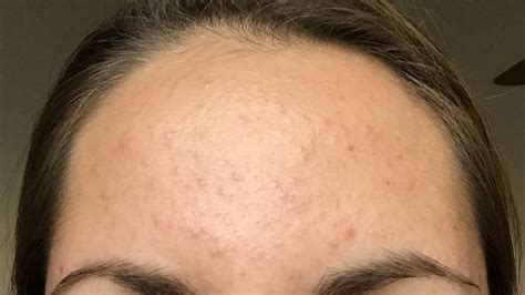 Looks Like Acne Could It Be Foliculitis General Acne Discussion