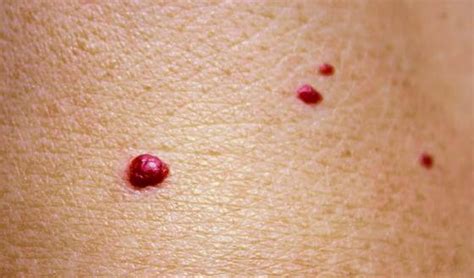 C est quoi ces petits points rouges sur la peau angiome rubis ou pétéchie PassionSanté be