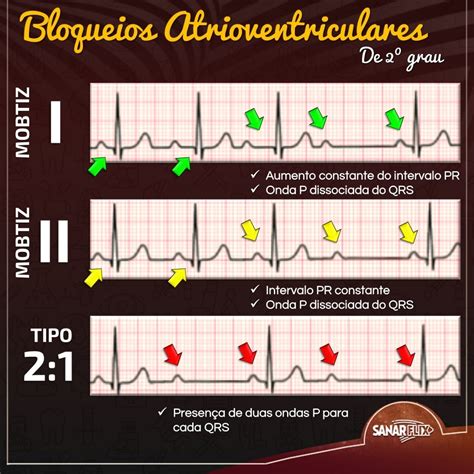 Dica De Cardiologia Bloqueios Atrioventriculares Sanar Medicina