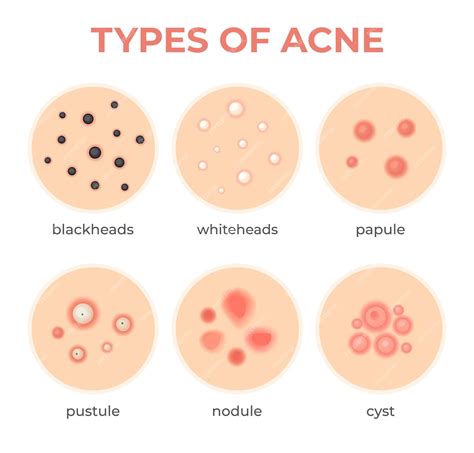 Premium Vector Acne Types Skin Infection Problem Pimples Grade And