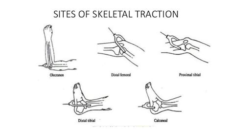 Skeletal Traction Pin Site Care