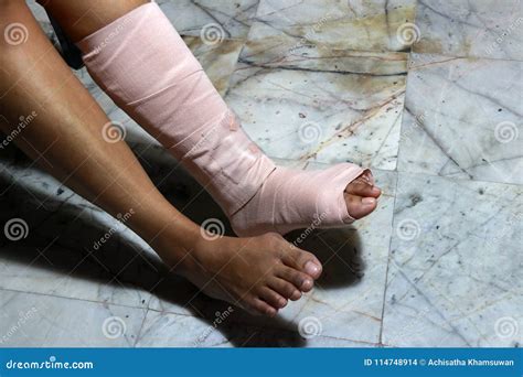 Left Legs And Feet Be In Plaster Cast Because Splintered Stock Photo