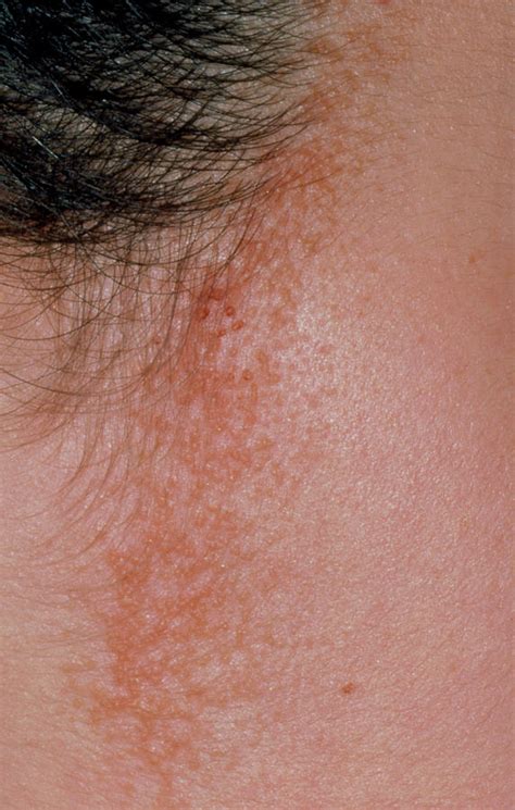 Seborrhoeic Dermatitis Around Hairline Photograph By Dr P Marazzi