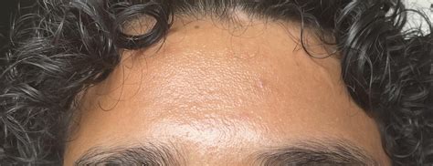 Skin Concern Ive Had This Strange Texture On My Forehead For A While