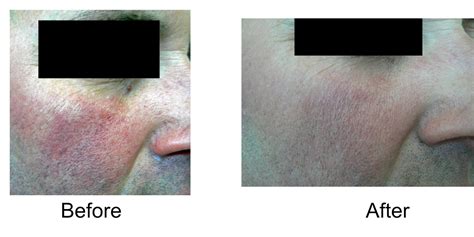 Rosacea Treatment Facial Veins And Rosacea Madison Vein And Laser
