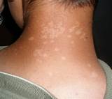 Tinea cruris — classification and external resources tinea cruris on the groin icd 10 b35.6 … Tinea Versicolor- A Cause of Circular Patches on the Trunk ...