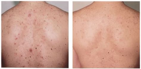 12 Simple Remedies To Get Rid Of Back Acne Fast