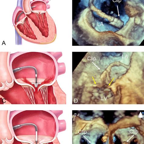 The Carillon Mitral Contour System A The Carillon Mitral Contour