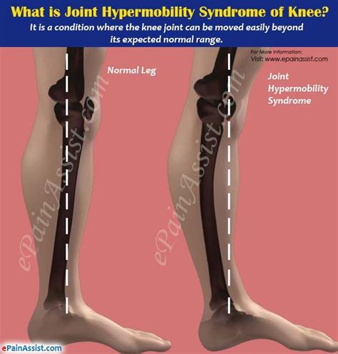 What Is Joint Hypermobility Syndrome Of Knee Or Double Jointed Knee Get It On