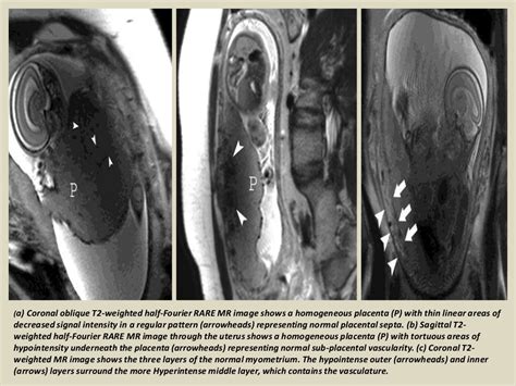 Presentation1 Radiological Imaging Of Placenta Accreta