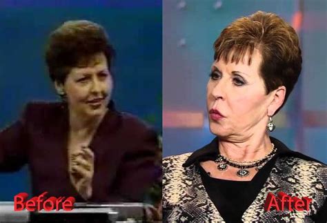 Joyce Meyer Plastic Surgery Before And After Joyce Meyer Plastic Surgery Celebrity Plastic