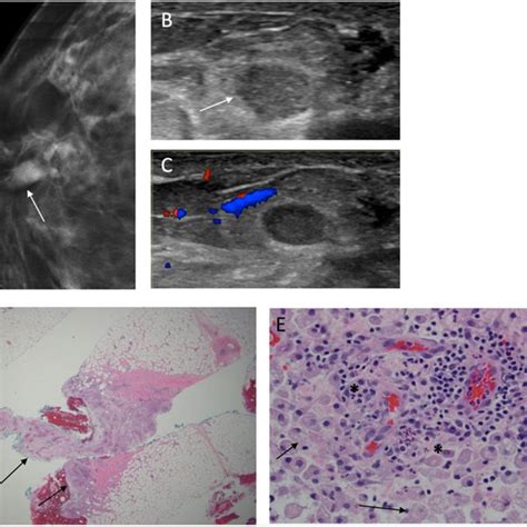 A Progression From Normal Breast Parenchyma To Acute Mastitis If
