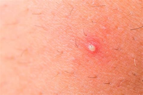 Skin Conditions That Look Like Acne But Arent Best Health Canada
