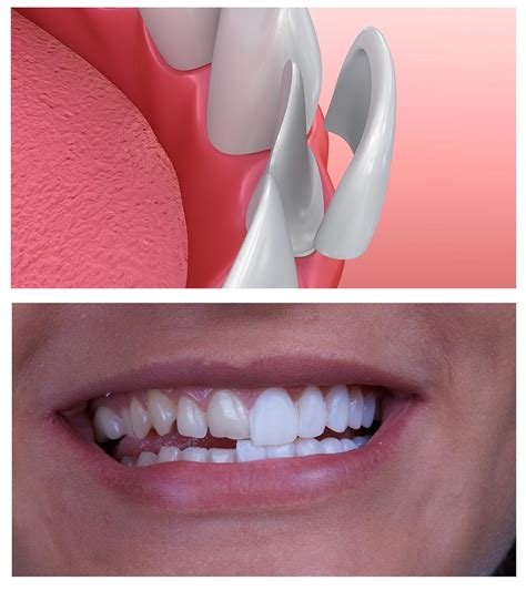 porcelain veneer pattaya smile dental clinic