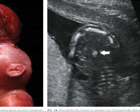 Figure 14 From Acrania Exencephaly Anencephaly Sequence Phenotypic Characterization Using Two