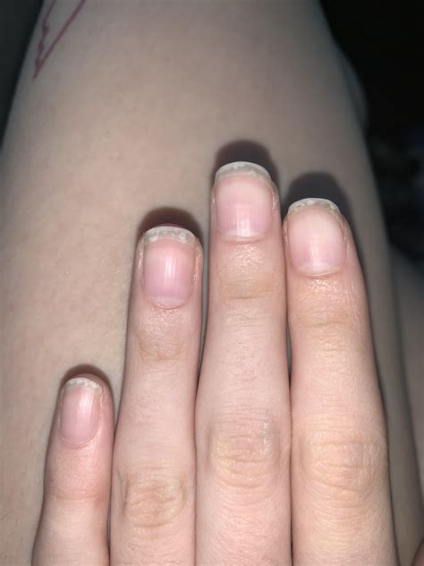 What Are These White Spots That Keep Appearing On My Nails More