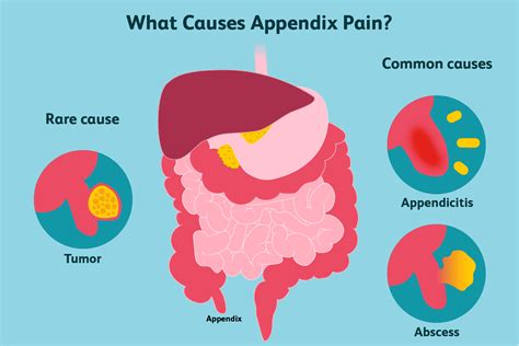 Appendicitis Diagnosis And Treatment