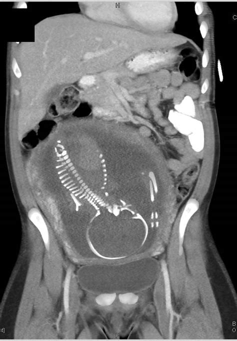 Ct Of Fetus In A Trauma Patient Obgyn Case Studies Ctisus Ct Scanning