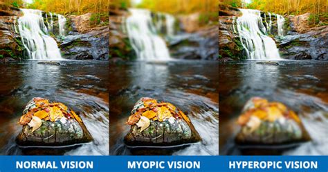 Myopia Causes Symptoms Treatments Apec