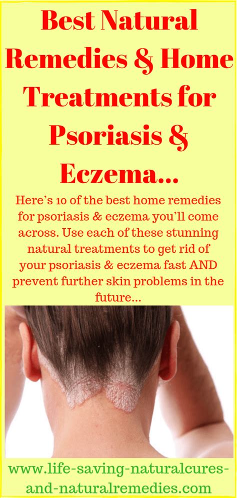 Top scalp psoriasis home remedies. 10 Powerful Natural Cures & Home Remedies for Psoriasis...