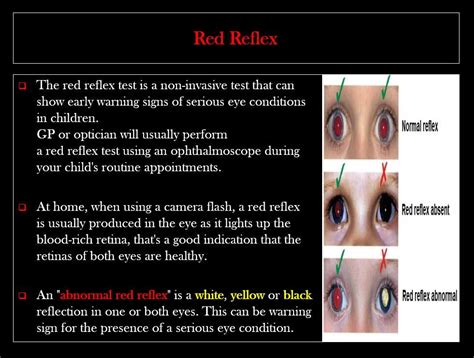 Red Reflex Literature Child Routine Ocular Camera Flash