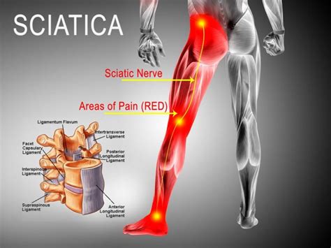 Sciatica Pain Carolinas Pain Center Pain In Your Back Felt In Legs