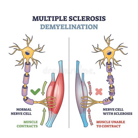 Multiple Sclerosis Demyelination Compared With Healthy Nerves Outline