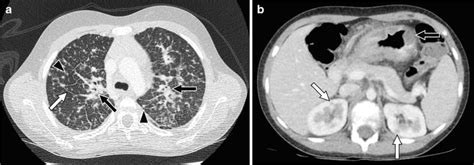 Pulmonary Lymphoma On Computed Tomography Ct In The Setting Of