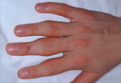Proximal Interphalangeal Joint Swelling