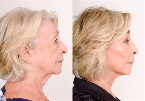 Cosmetic Neck Lift Surgeries In Toronto Dr Cory Torgerson