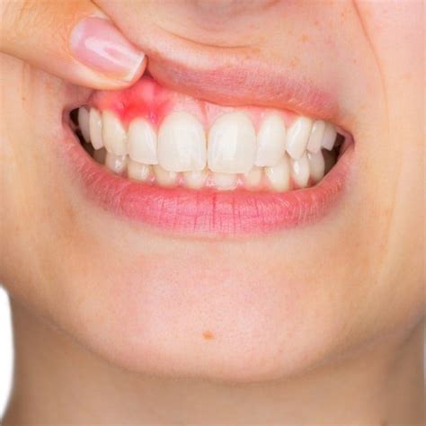 Oral Infection Types Causes Treatment Diagnosis And Prevention
