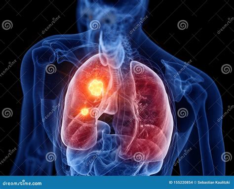 Lung Cancer Stock Illustration Illustration Of Body 155220854