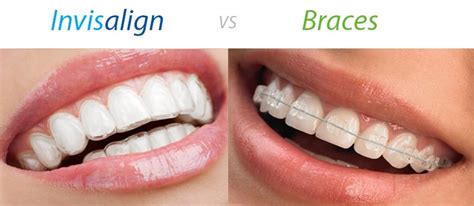 Invisalign Vs Braces Weighing The Pros And Cons Mysmilect
