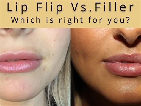 All About The Lip Flip Harbour Medispa Wilston Cosmetic Injections