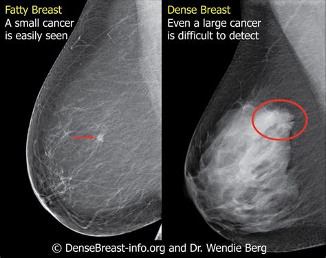 9 Best Dense Breast Info Images On Pinterest Breast Breast Cancer