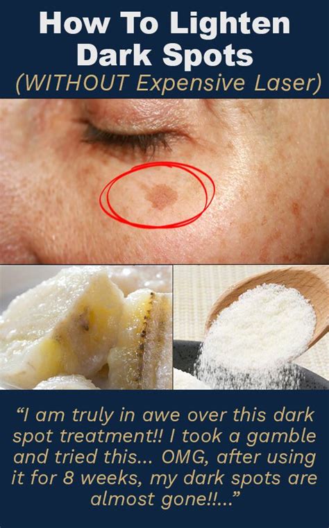How To Fade Dark Spots Naturally Fade Dark Spots Dark Spot Treatment