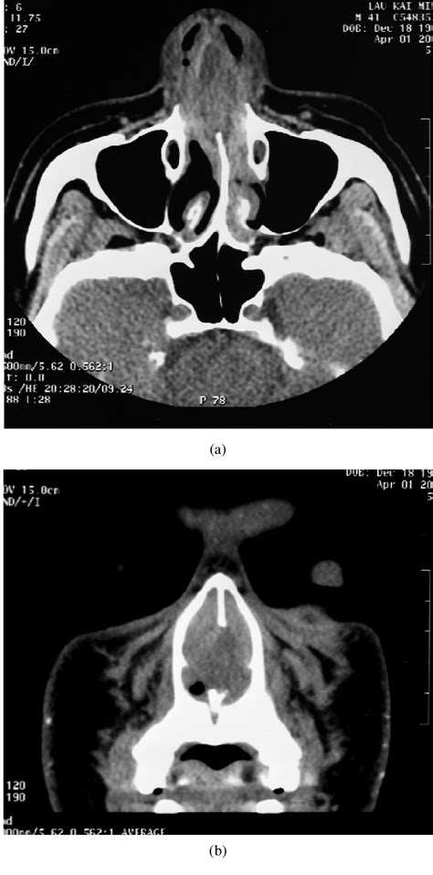 Figure 2 From Spontaneous Nasal Septal Abscess Presenting As Complete Nasal Obstruction