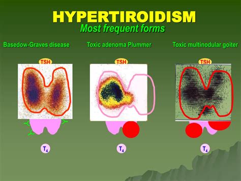 Ppt Hyperthyroidism Powerpoint Presentation Free Download Id9452472