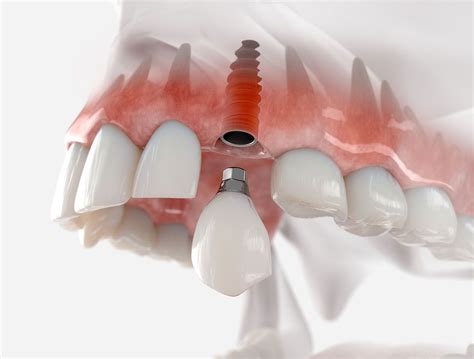 Dental Implants Charleston Sc Implant Dentistry Oral And Implant
