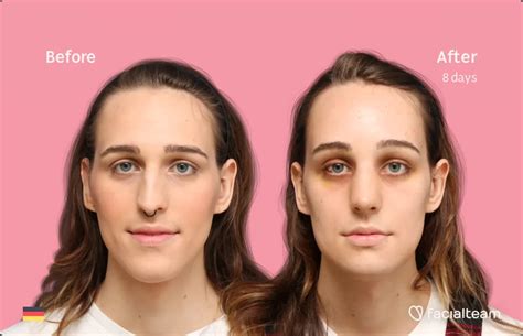 Experts In Facial Feminization Surgery — Facialteam