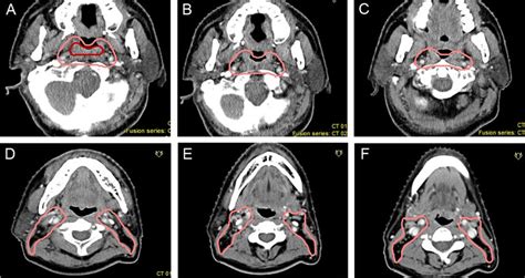 Proposed Ctvdelineation Protocol For Retropharyngeal Lymph Nodes A C